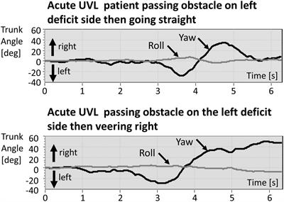 Acute unilateral vestibular neuritis contributes to alterations in vestibular function modulating circumvention around obstacles: A pilot study suggesting a role for vestibular signals in the spatial perception of orientation during circumvention